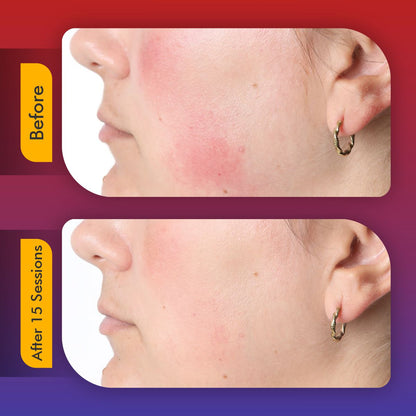 Ergonomist ® LED Face Mask